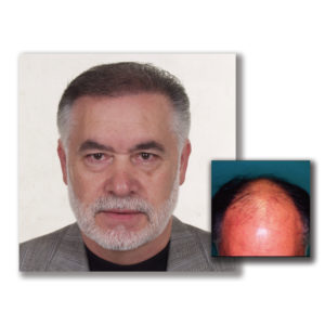 Read more about the article Hair Transplant Recovery Guide: 2026 Data