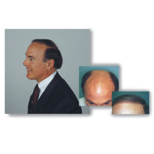 Read more about the article Hair Transplant Statistics: 2026 Report