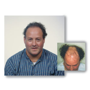 Read more about the article Hair Transplant Results Timeline: 2026 Data