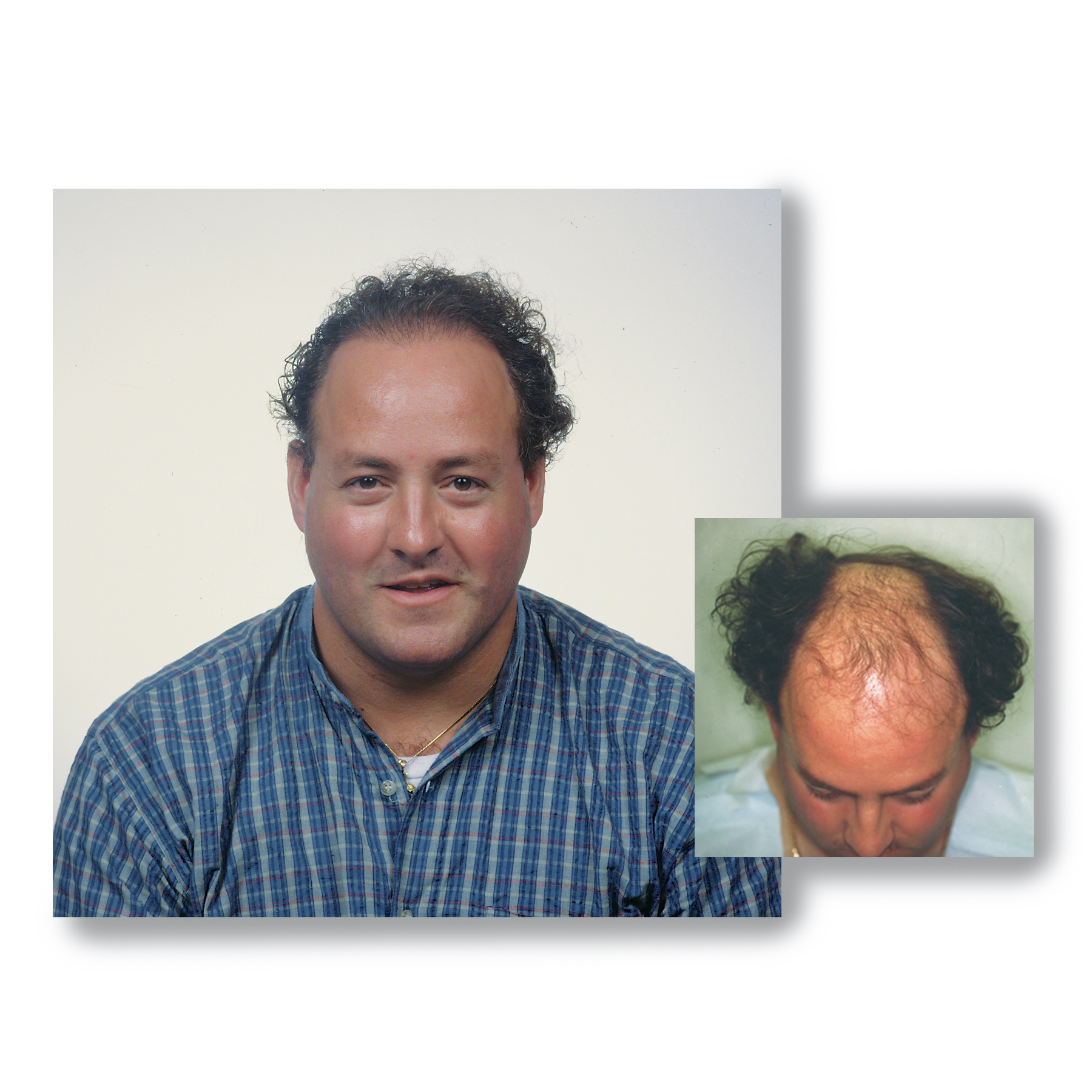 Read more about the article Hair Transplant Results Timeline: 2026 Data