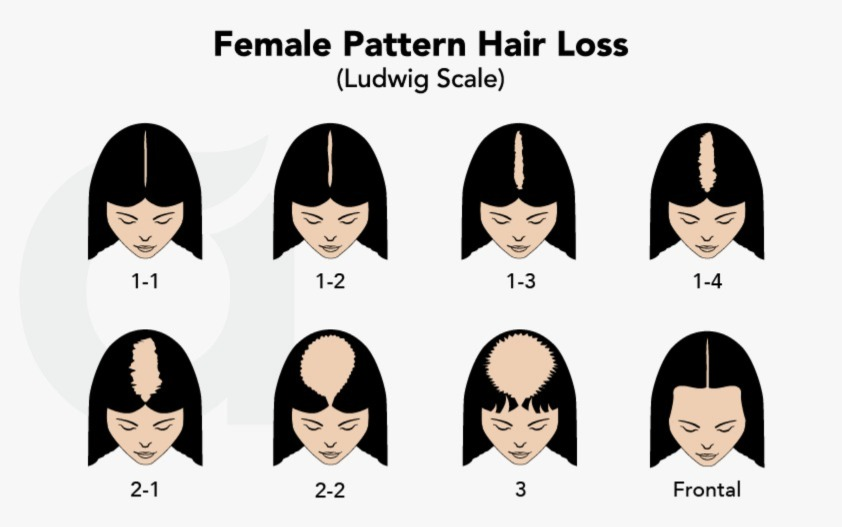 Ludwig female hair loss chart