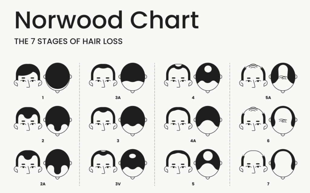 Norwood male hair loss chart