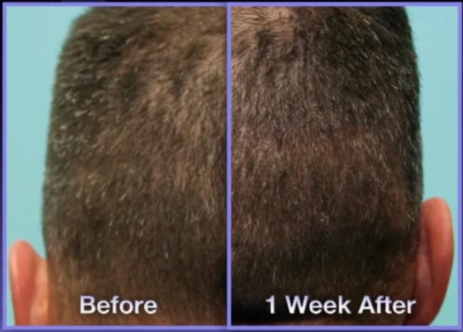 Man's head of hair before and after manual FUE transplant surgery